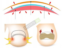 Лепенки за врасъл нокът 50бр.-foto4
